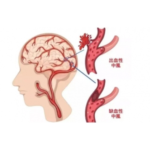 為什么中國腦梗越來越多，美國卻在減少？醫(yī)生：主要原因有這3點(diǎn)